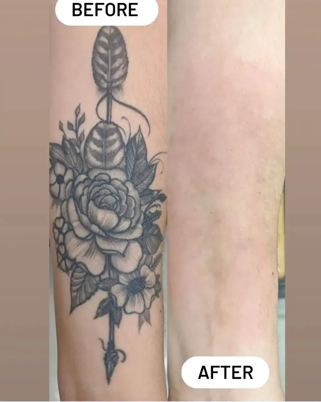 Bonsai Laser Tattoo Removal — Tattoo removal service in Rowlett
